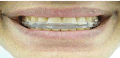 Grinding and clenching of teeth cause havoc with  you quality of life - make sure you manage it before it reduces your quality of life
