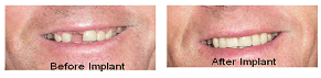 Implants replace teeth, maintain bone, prevents addtional tooth loss and sunken face look - making you look and feel younger!